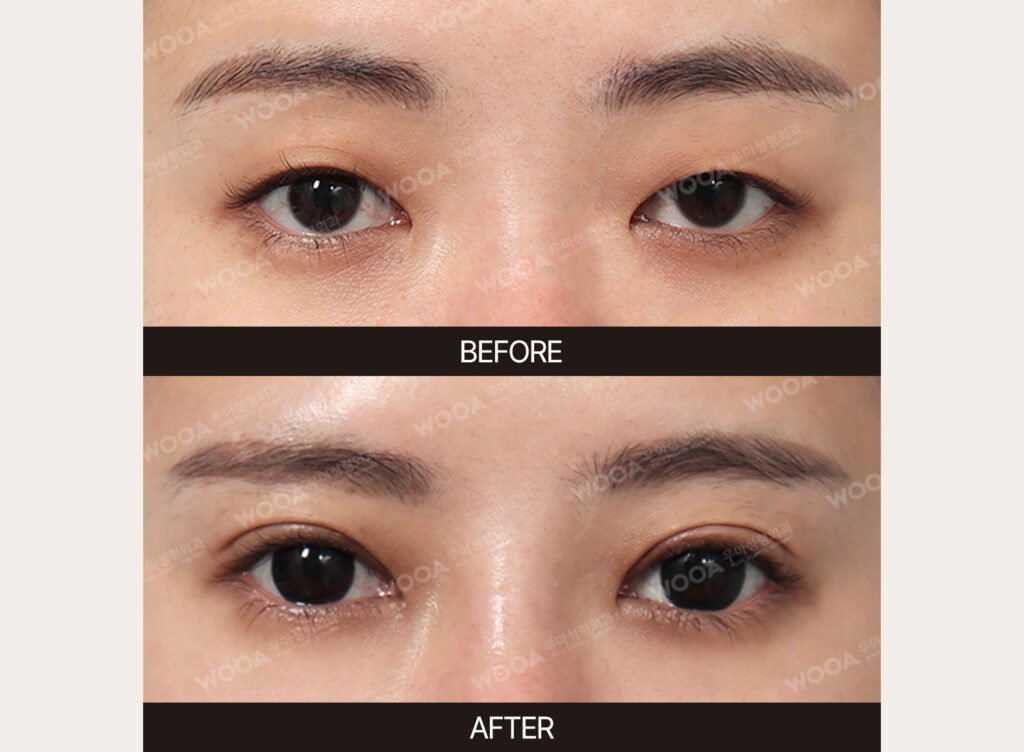 Double Eyelid Surgery before and after – Case 02 – WOOA Plastic Surgery Gangnam