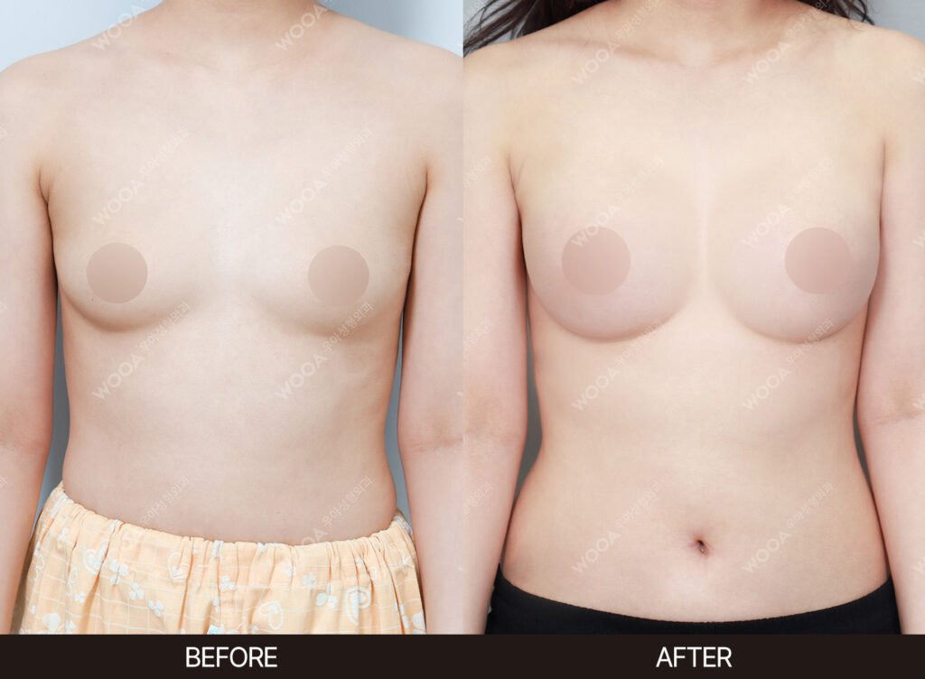 Breast Augmentation before and after – Case 33 – WOOA Plastic Surgery Gangnam