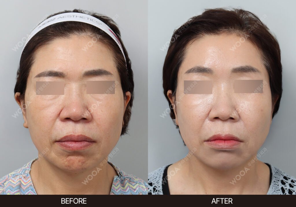 Forehead Lift before and after – Case 02 – WOOA Plastic Surgery Gangnam