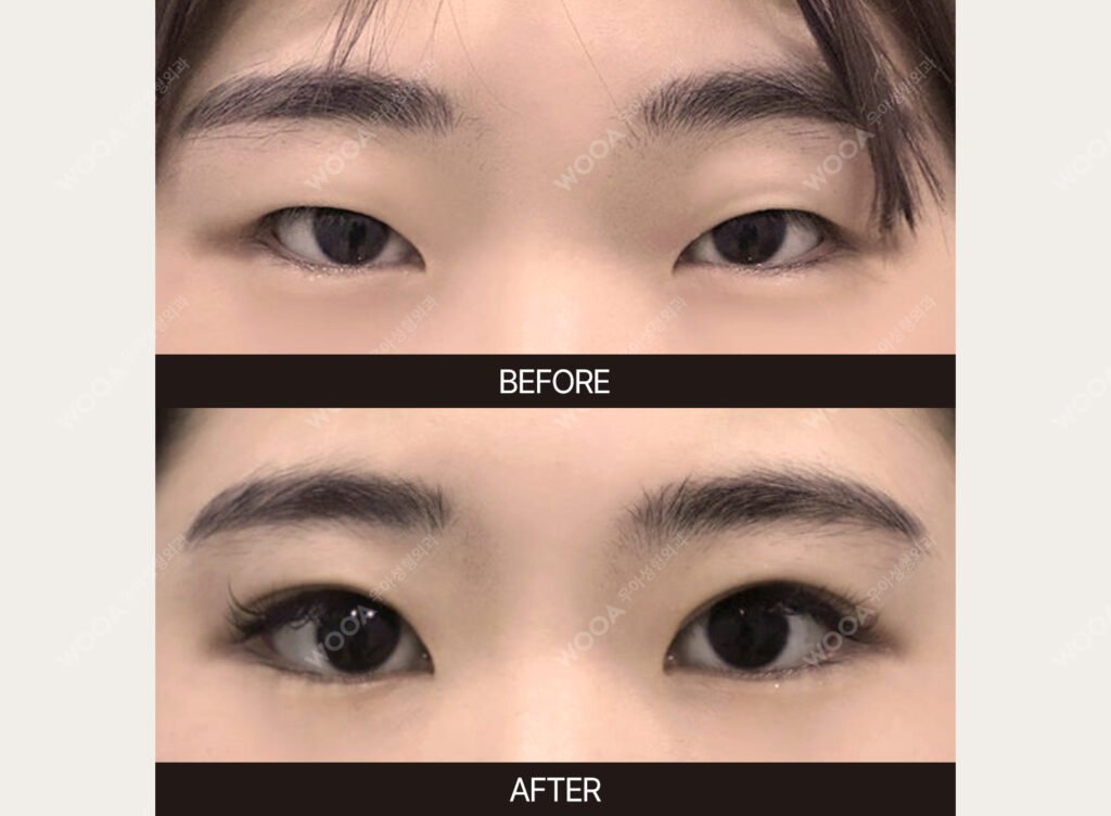 Double Eyelid Surgery before and after – Case 18 – WOOA Plastic Surgery Gangnam