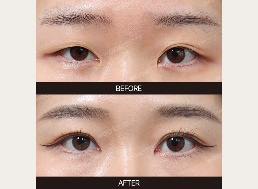 Double Eyelid Surgery before and after – Case 04 – WOOA Plastic Surgery Gangnam