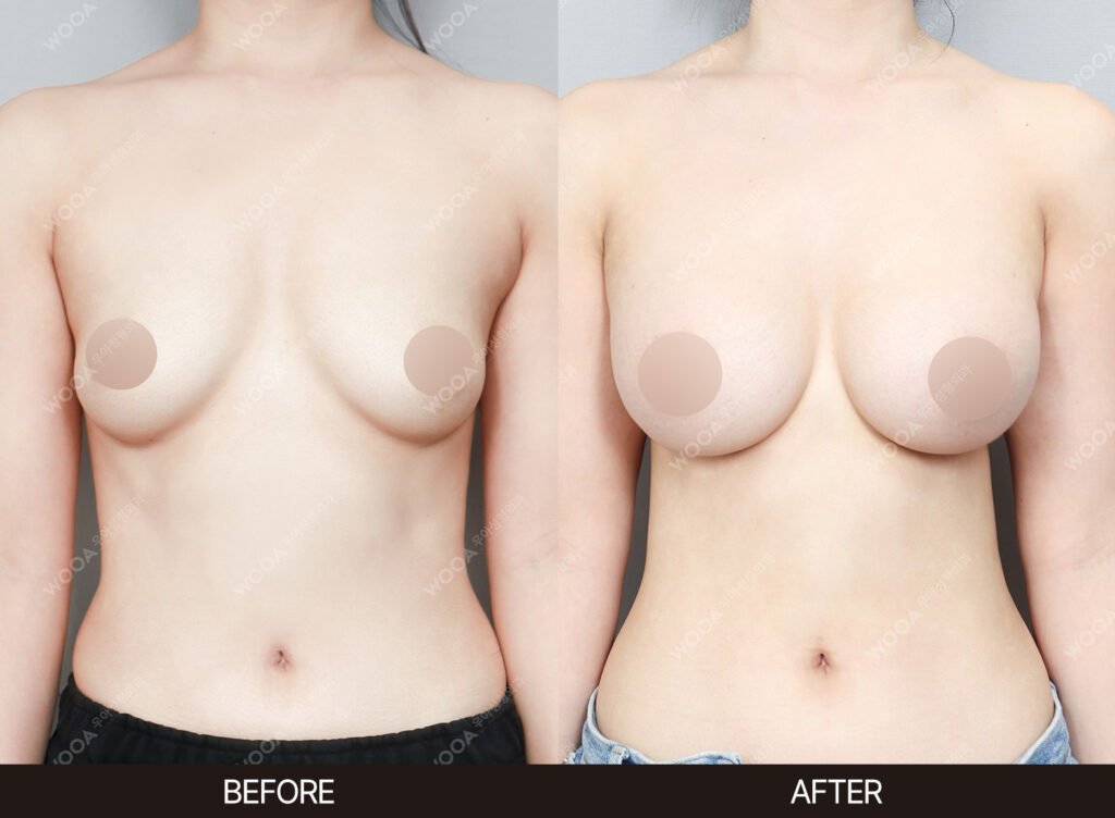 Breast Augmentation before and after – Case 51 – WOOA Plastic Surgery Gangnam
