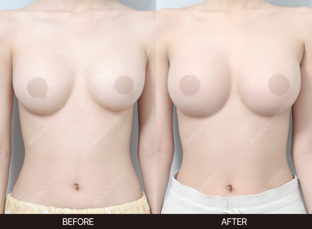 Breast Revision Surgery before and after – Case 07 – WOOA Plastic Surgery Gangnam