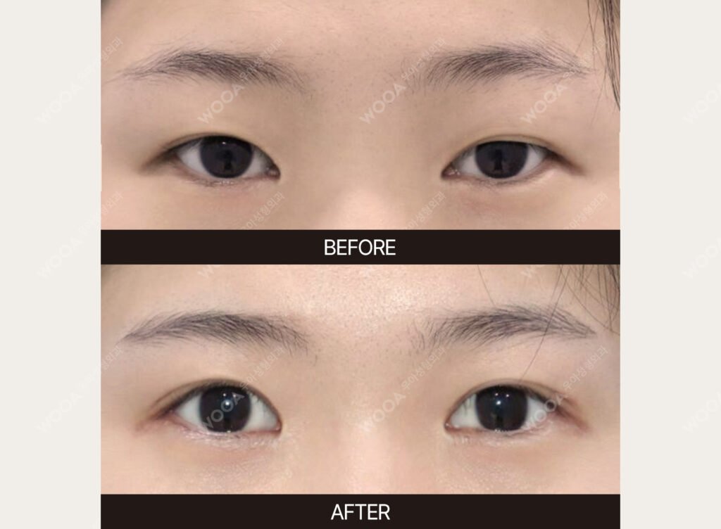 Double Eyelid Surgery before and after – Case 09 – WOOA Plastic Surgery Gangnam