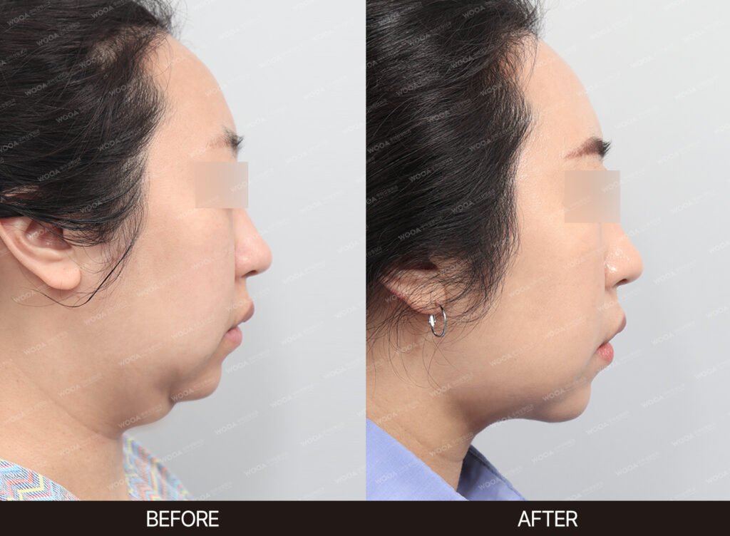 Double Chin Muscle Tightening before and after – Case 05 – WOOA Plastic Surgery Gangnam
