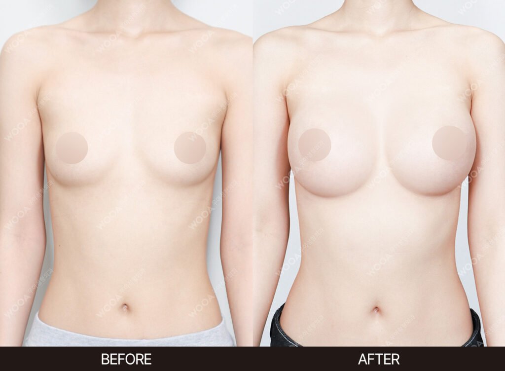 Breast Augmentation before and after – Case 37 – WOOA Plastic Surgery Gangnam