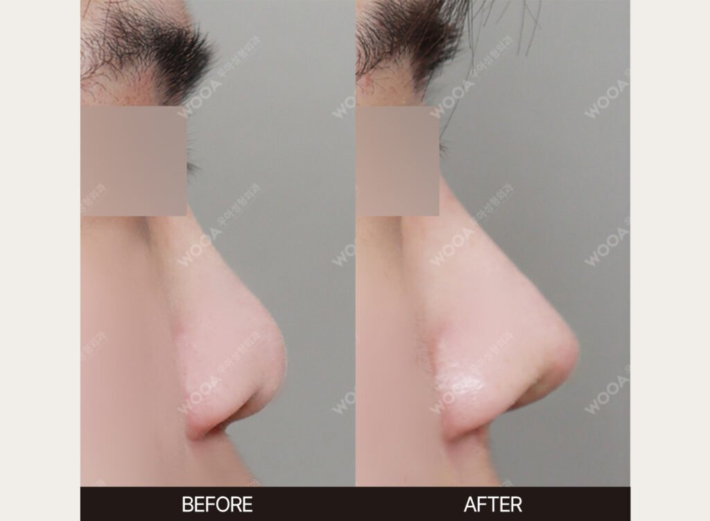 Rib Cartilage Rhinoplasty before and after – Case 02 – WOOA Plastic Surgery Gangnam