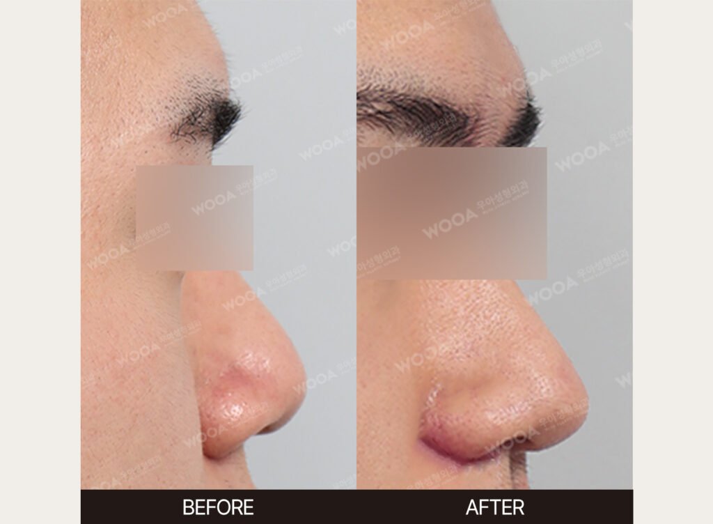 Bulbous Nose Tip Refinement before and after – Case 03 – WOOA Plastic Surgery Gangnam