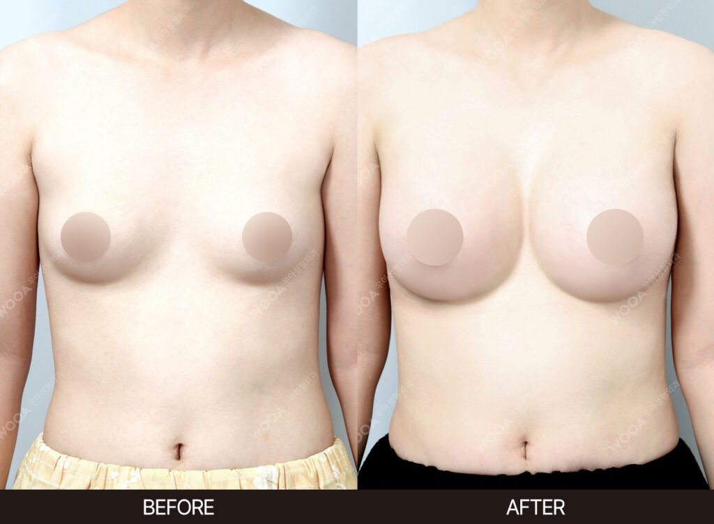 Breast Augmentation before and after – Case 11 – WOOA Plastic Surgery Gangnam