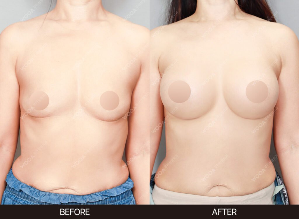 Breast Augmentation before and after – Case 46 – WOOA Plastic Surgery Gangnam