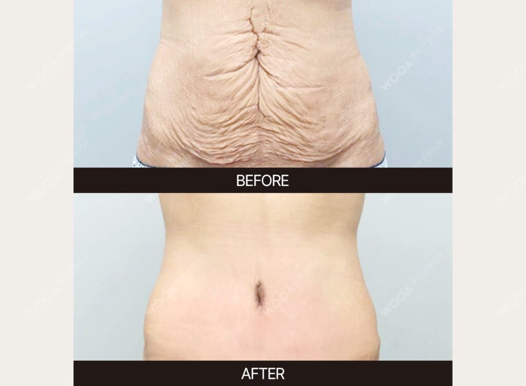 Tummy Tuck (Abdominal Body Lift) before and after – Case 05 – WOOA Plastic Surgery Gangnam