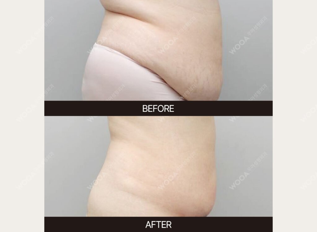Tummy Tuck (Abdominal Body Lift) before and after – Case 07 – WOOA Plastic Surgery Gangnam