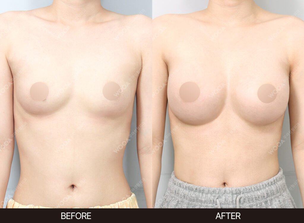 Breast Augmentation before and after – Case 12 – WOOA Plastic Surgery Gangnam