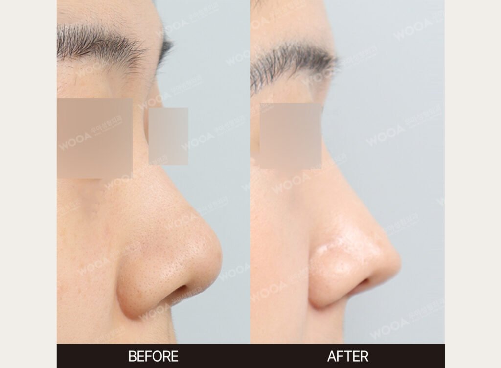 Revision Rhinoplasty before and after – Case 08 – WOOA Plastic Surgery Gangnam