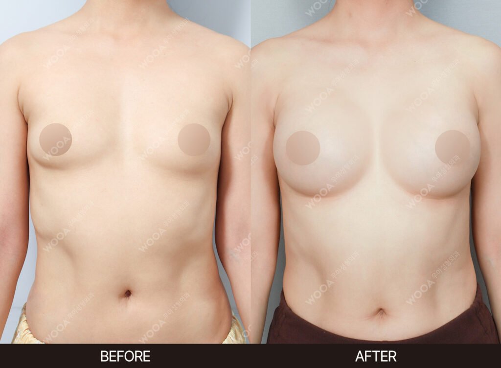 Breast Augmentation before and after – Case 23 – WOOA Plastic Surgery Gangnam