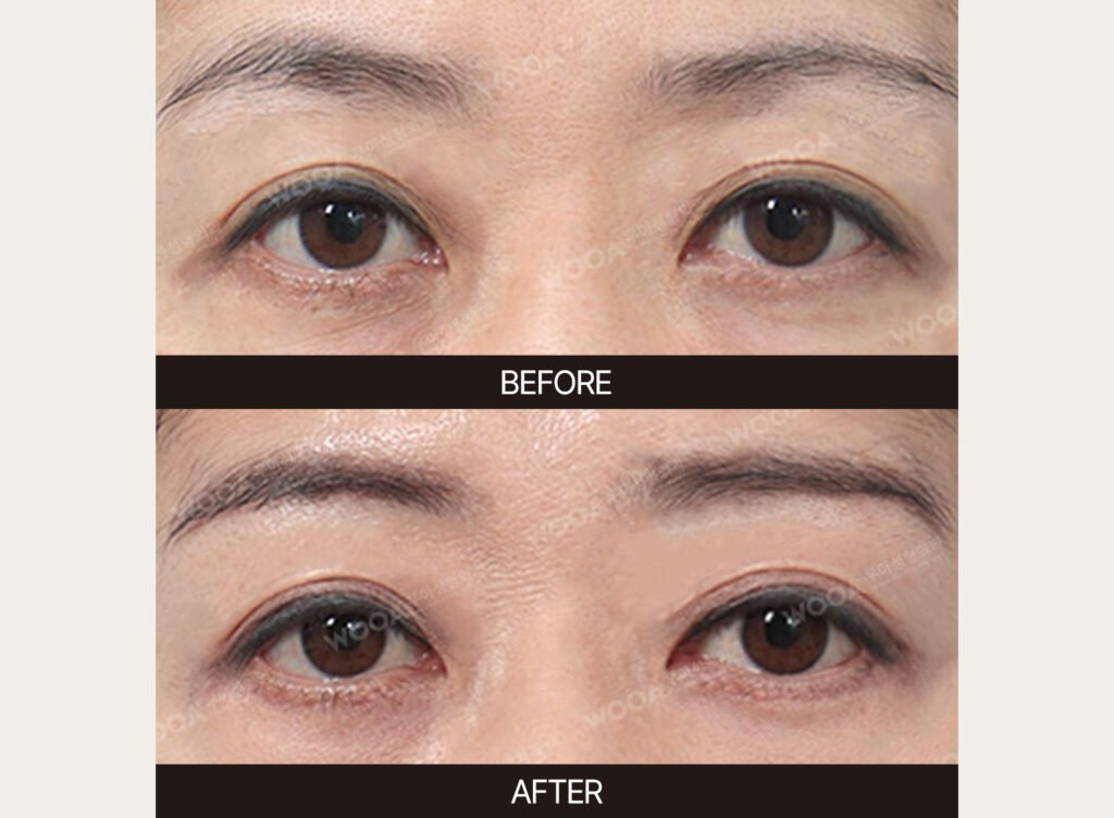 Lower Blepharoplasty before and after – Case 03 – WOOA Plastic Surgery Gangnam