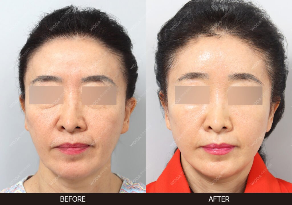 Forehead Lift before and after – Case 04 – WOOA Plastic Surgery Gangnam