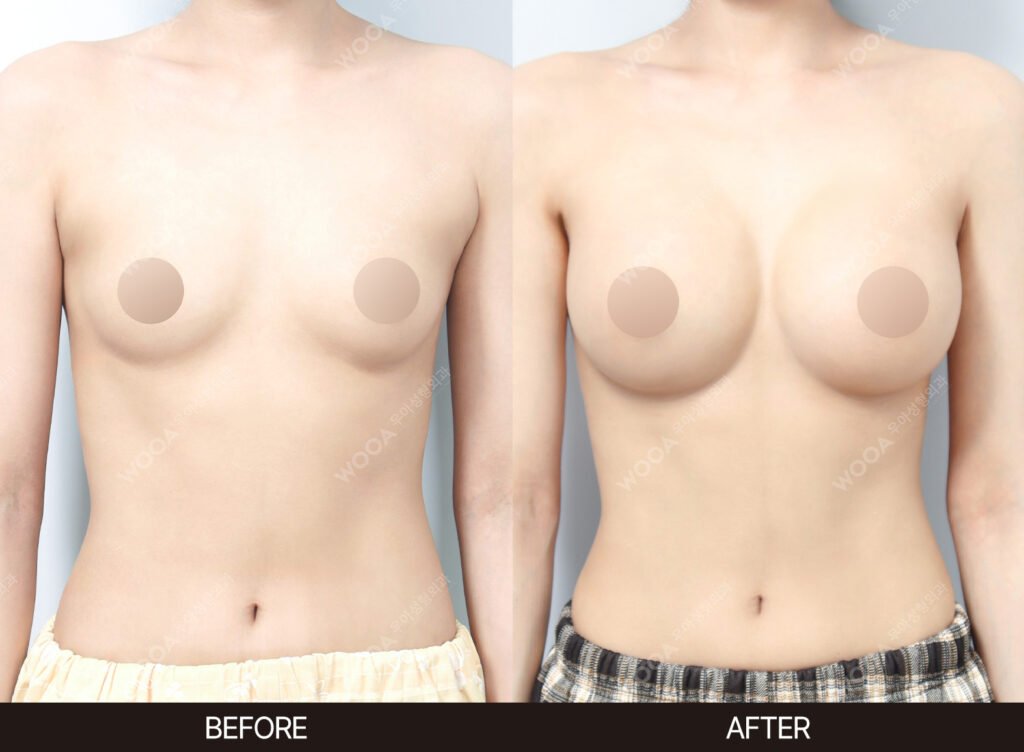 Breast Augmentation before and after – Case 13 – WOOA Plastic Surgery Gangnam