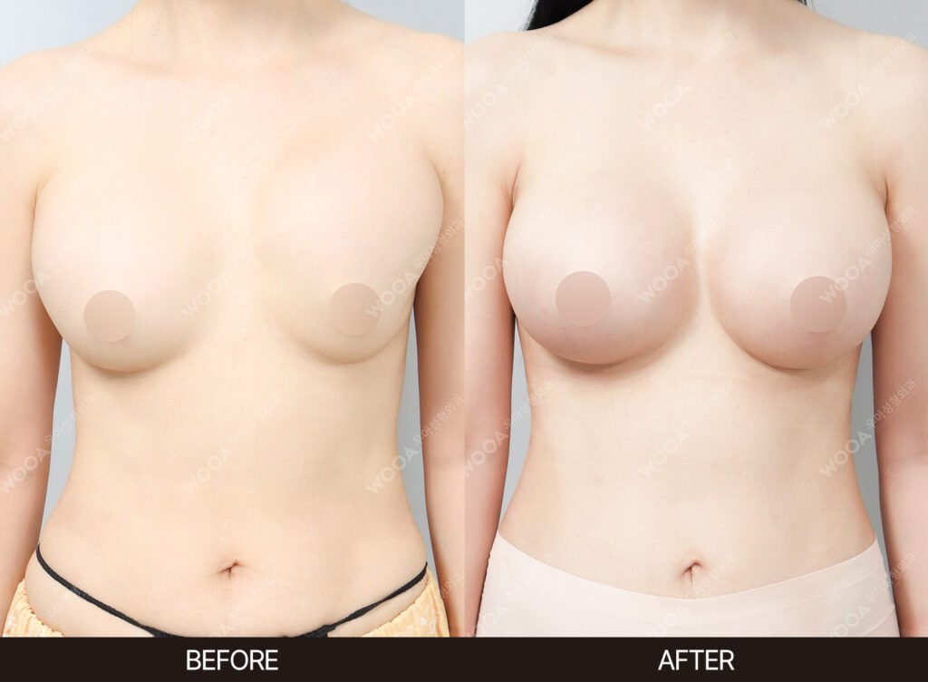Breast Revision Surgery before and after – Case 01 – WOOA Plastic Surgery Gangnam