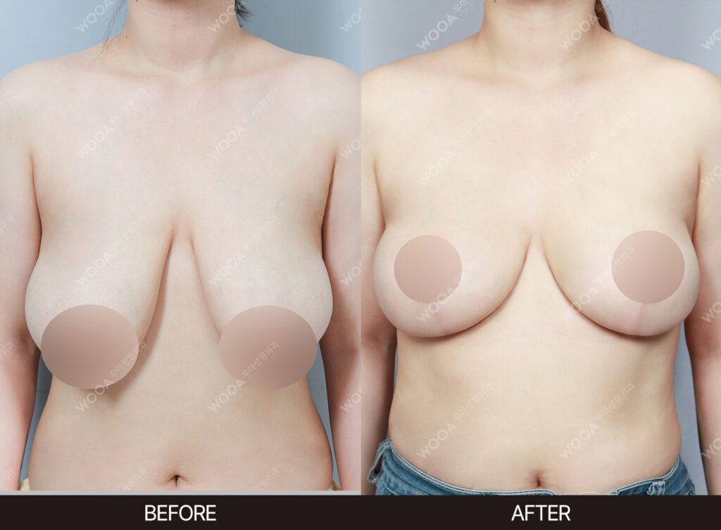 Breast Reduction before and after – Case 03 – WOOA Plastic Surgery Gangnam