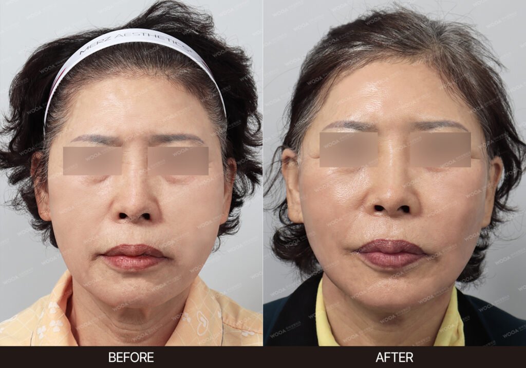 Neck Lift before and after – Case 02 – WOOA Plastic Surgery Gangnam