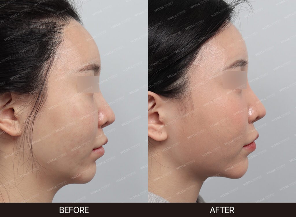 Double Chin Muscle Tightening before and after – Case 01 – WOOA Plastic Surgery Gangnam