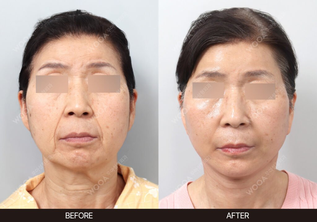 Forehead Lift before and after – Case 01 – WOOA Plastic Surgery Gangnam