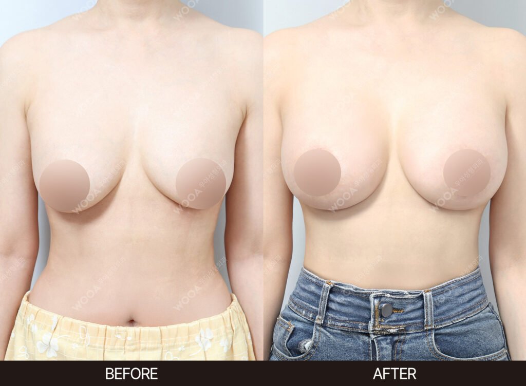 Breast Revision Surgery before and after – Case 04 – WOOA Plastic Surgery Gangnam