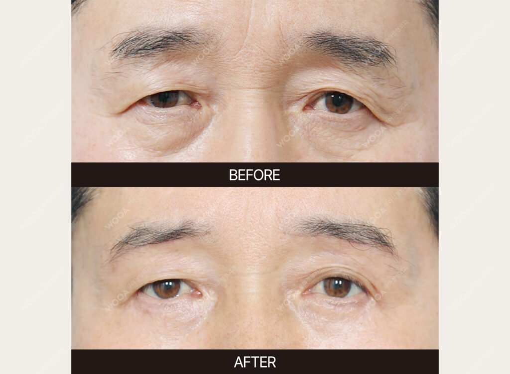 Brow Lift before and after – Case 03 – WOOA Plastic Surgery Gangnam