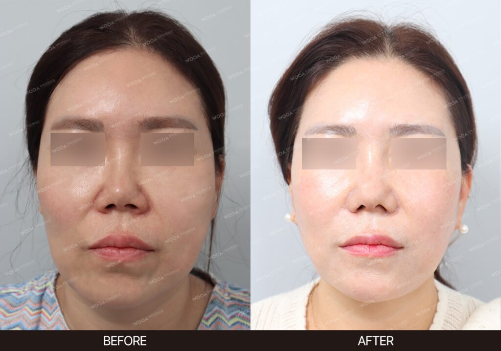SMAS Facelift before and after – Case 07 – WOOA Plastic Surgery Gangnam