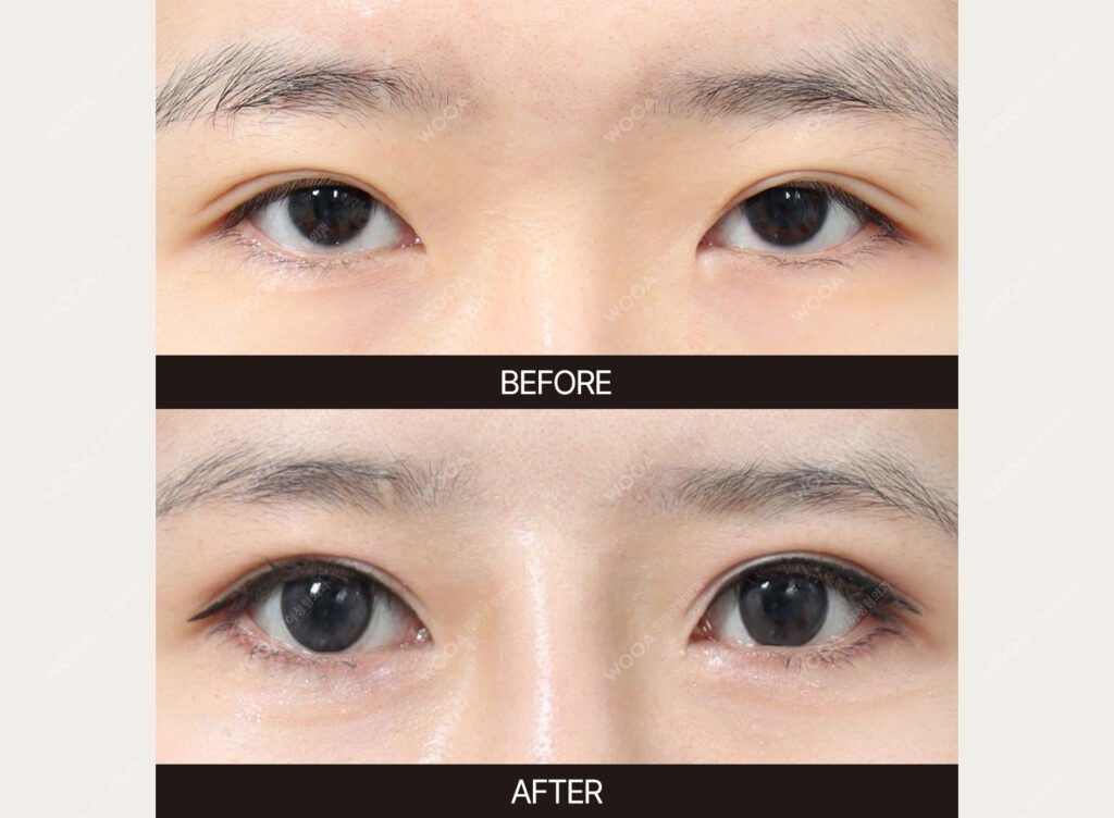 Eye Revision Surgery before and after – Case 05 – WOOA Plastic Surgery Gangnam