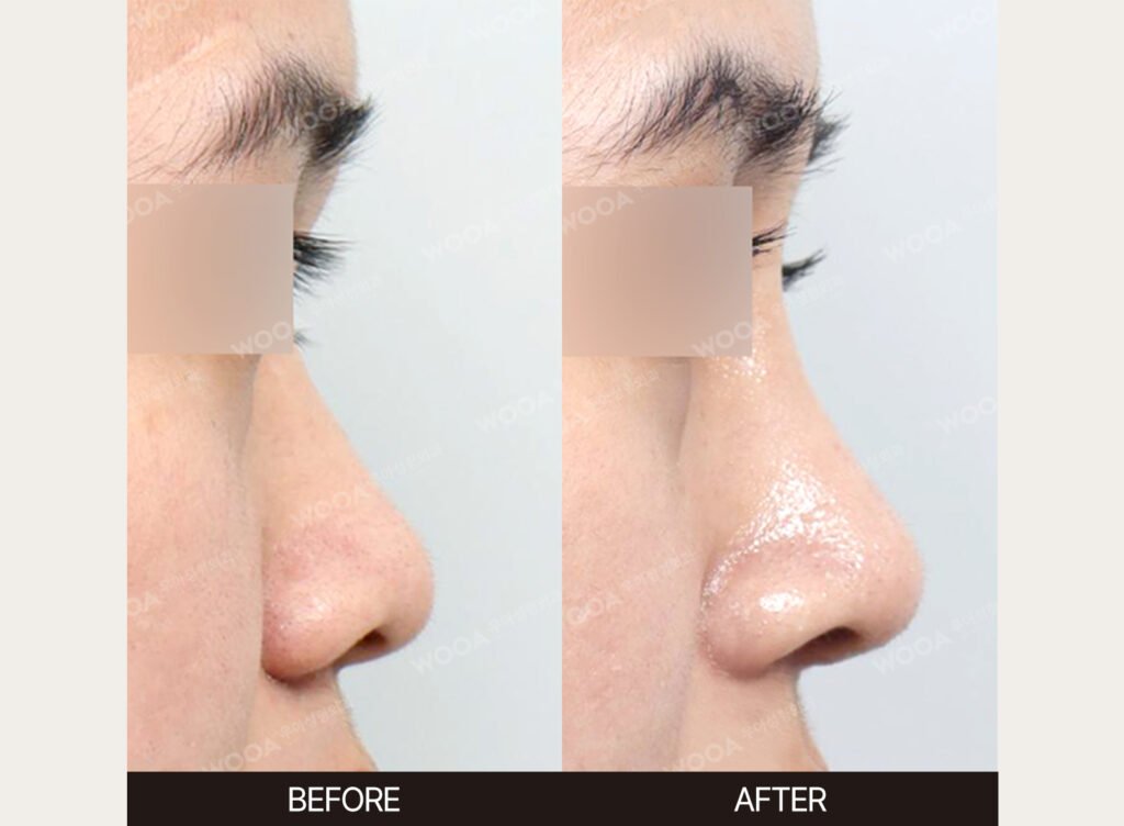 Dorsal Hump Correction before and after – Case 07 – WOOA Plastic Surgery Gangnam