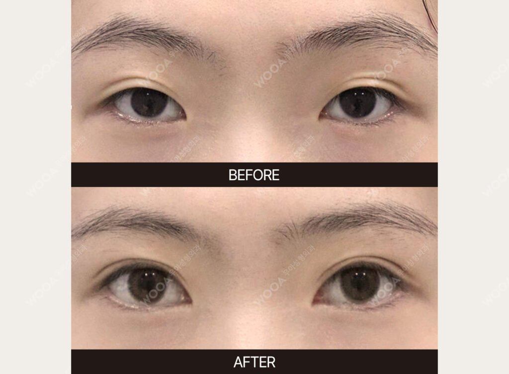 Double Eyelid Surgery before and after – Case 17 – WOOA Plastic Surgery Gangnam
