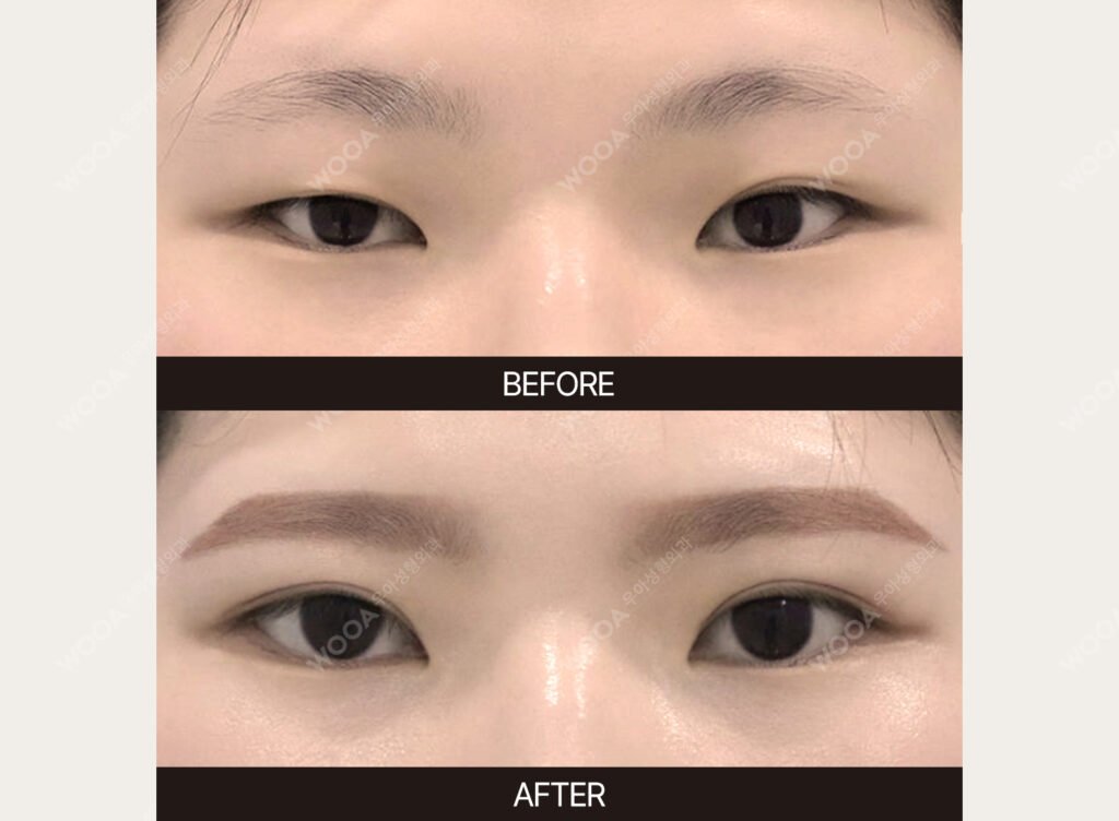 Double Eyelid Surgery before and after – Case 13 – WOOA Plastic Surgery Gangnam