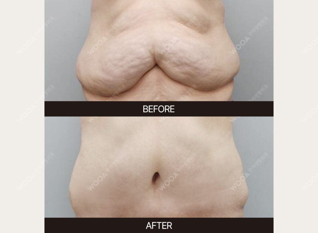 Tummy Tuck (Abdominal Body Lift) before and after – Case 01 – WOOA Plastic Surgery Gangnam