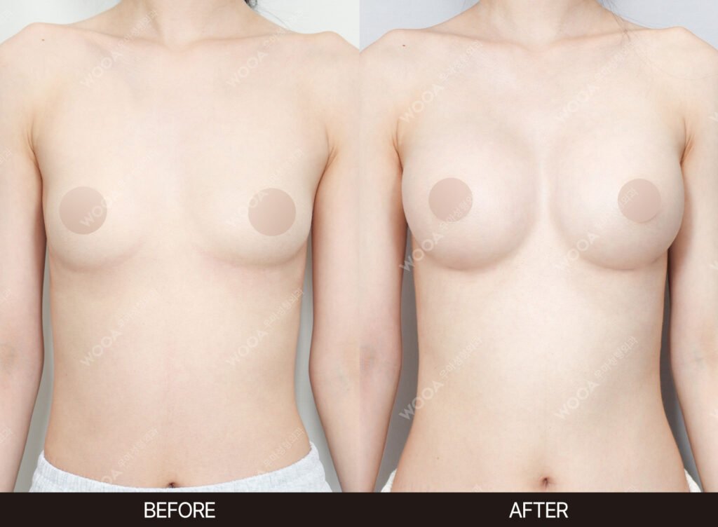 Breast Augmentation before and after – Case 38 – WOOA Plastic Surgery Gangnam