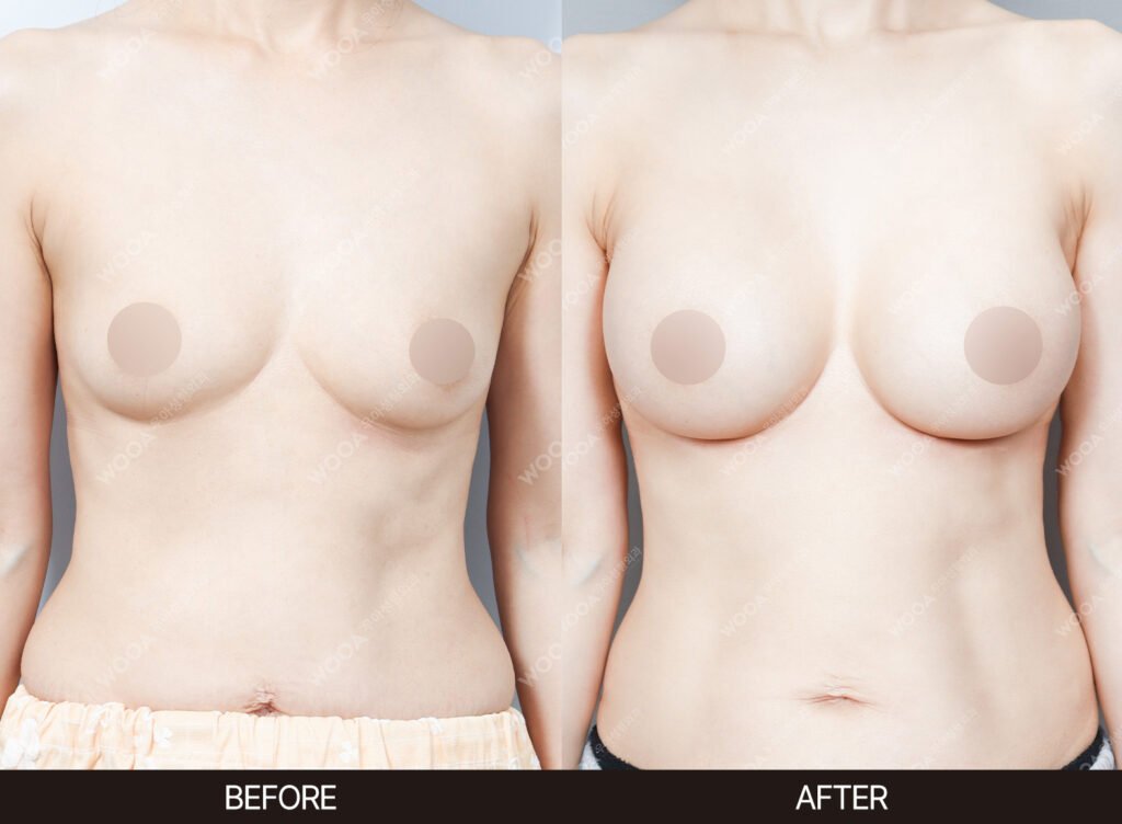 Breast Augmentation before and after – Case 54 – WOOA Plastic Surgery Gangnam