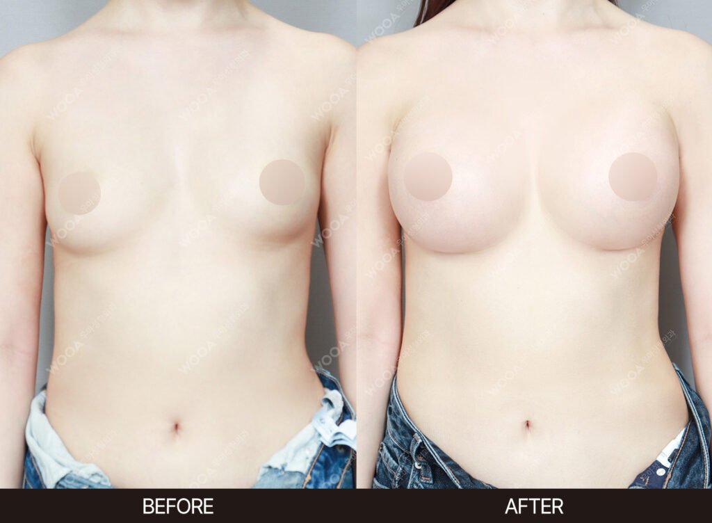 Breast Augmentation before and after – Case 48 – WOOA Plastic Surgery Gangnam