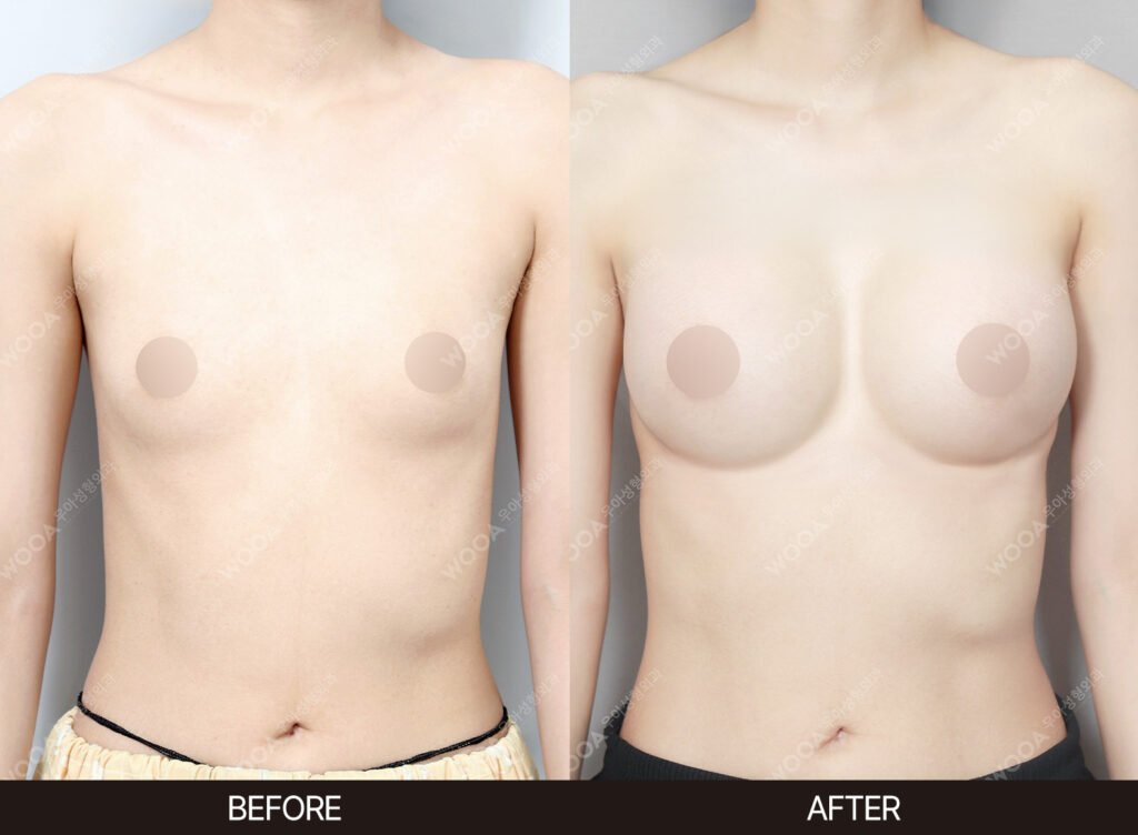 Breast Augmentation before and after – Case 20 – WOOA Plastic Surgery Gangnam