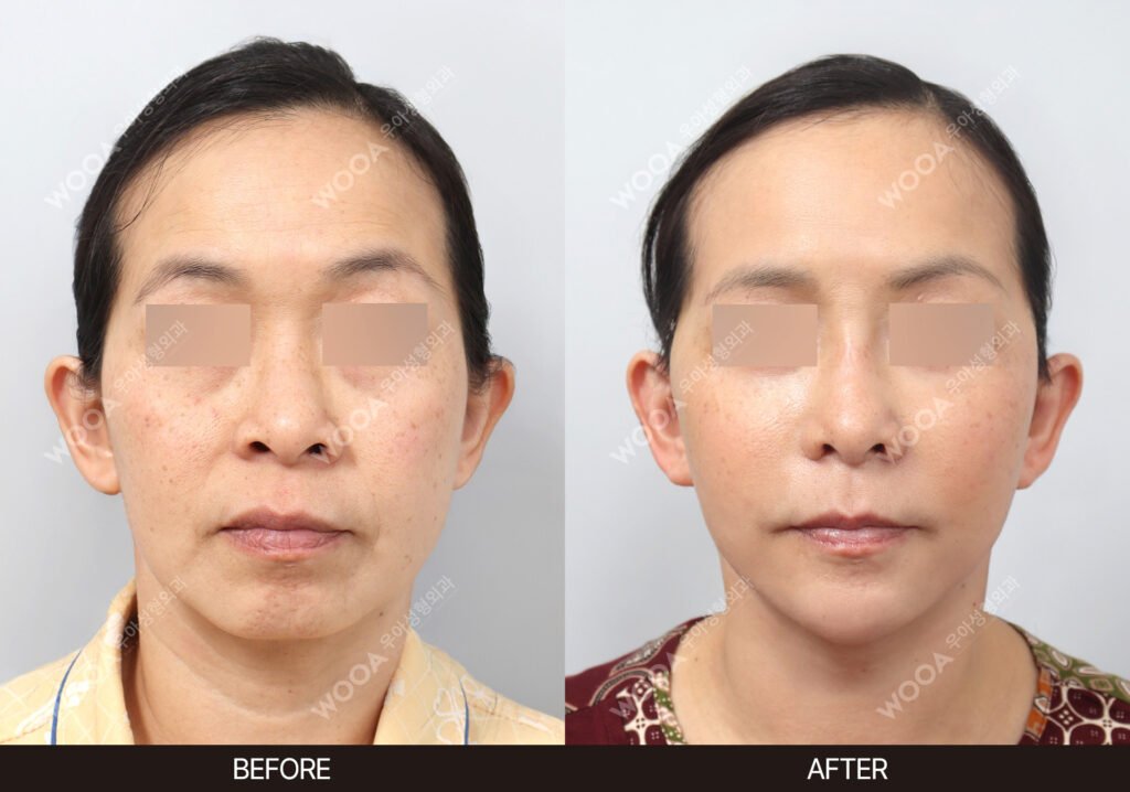 SMAS Facelift before and after – Case 06 – WOOA Plastic Surgery Gangnam