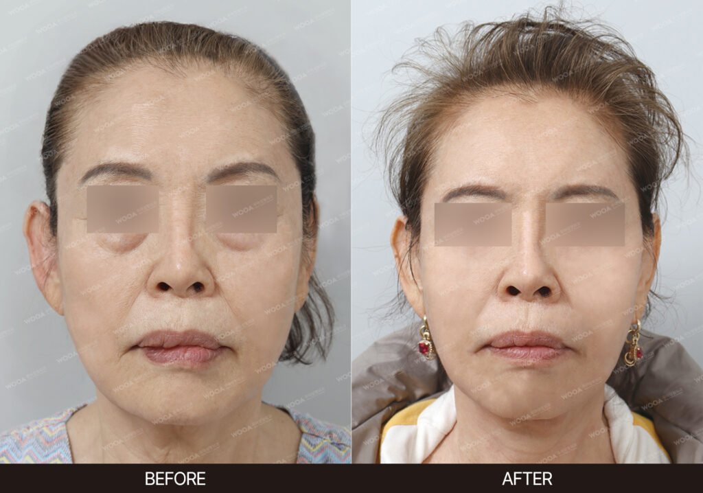 Neck Lift before and after – Case 01 – WOOA Plastic Surgery Gangnam