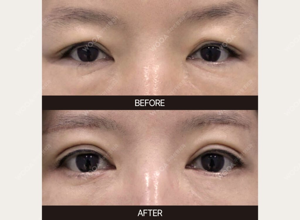 Lower Blepharoplasty before and after – Case 11 – WOOA Plastic Surgery Gangnam