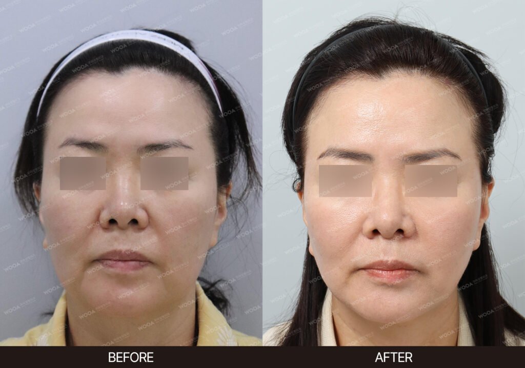 SMAS Facelift before and after – Case 01 – WOOA Plastic Surgery Gangnam