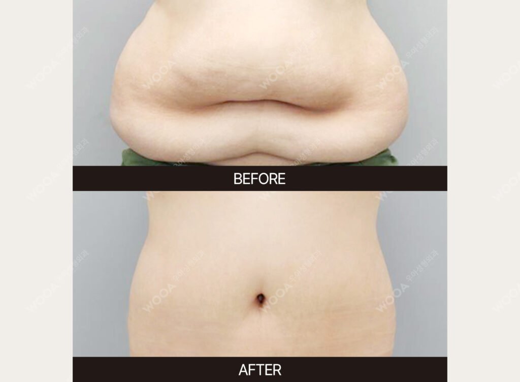 Tummy Tuck (Abdominal Body Lift) before and after – Case 03 – WOOA Plastic Surgery Gangnam