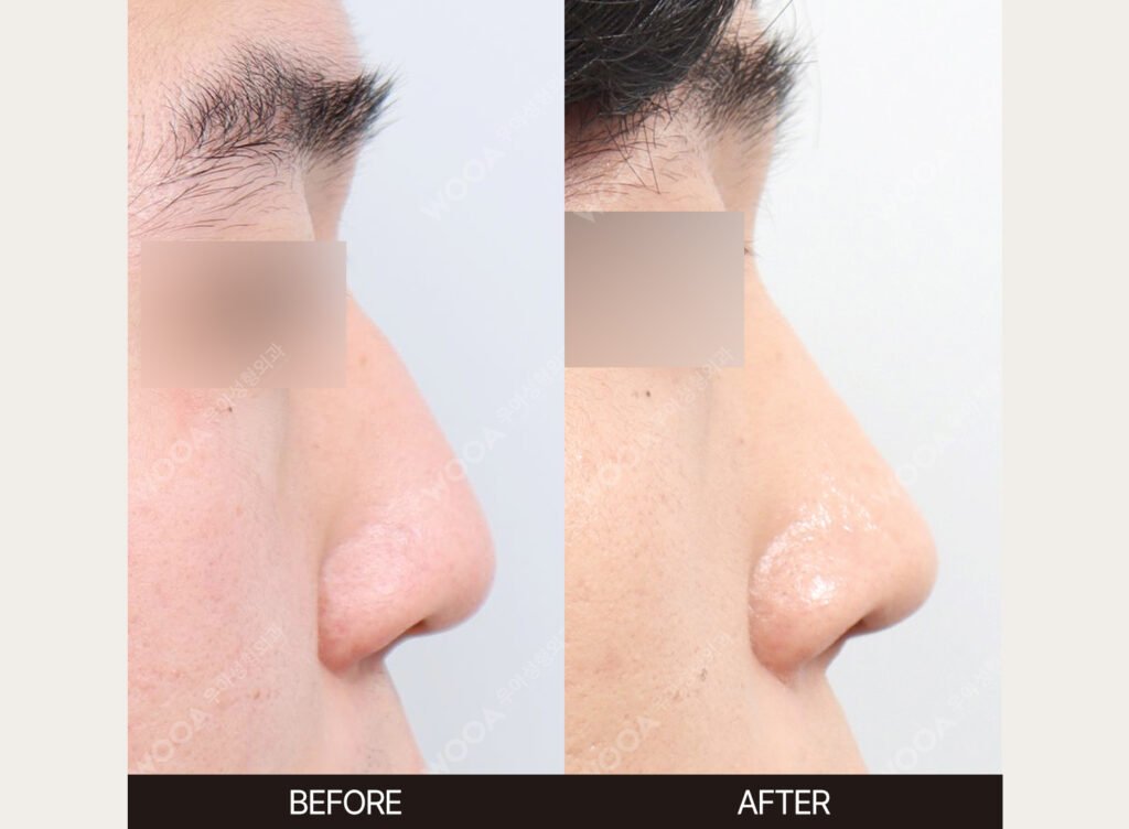 Dorsal Hump Correction before and after – Case 01 – WOOA Plastic Surgery Gangnam