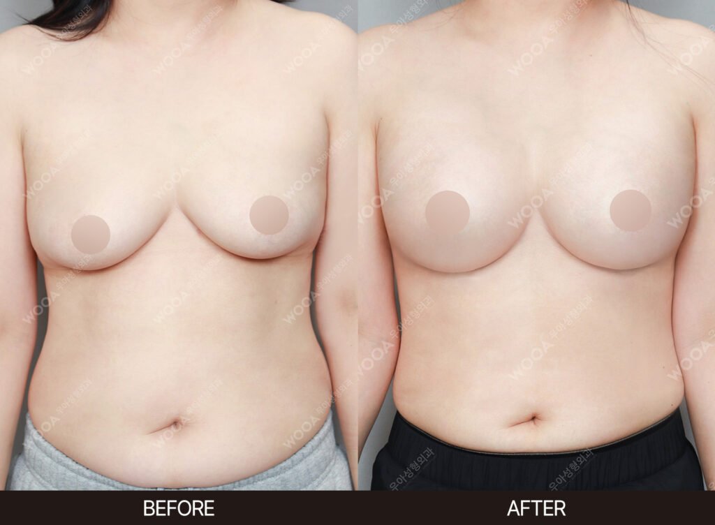 Breast Augmentation before and after – Case 53 – WOOA Plastic Surgery Gangnam