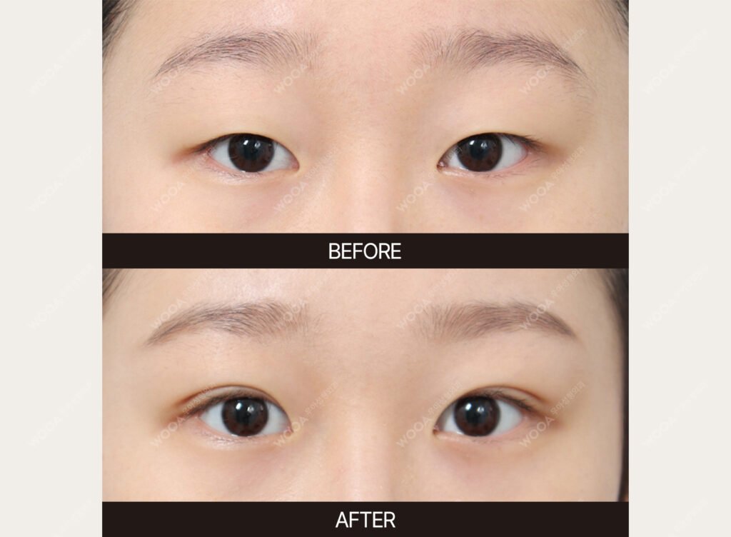 Double Eyelid Surgery before and after – Case 20 – WOOA Plastic Surgery Gangnam