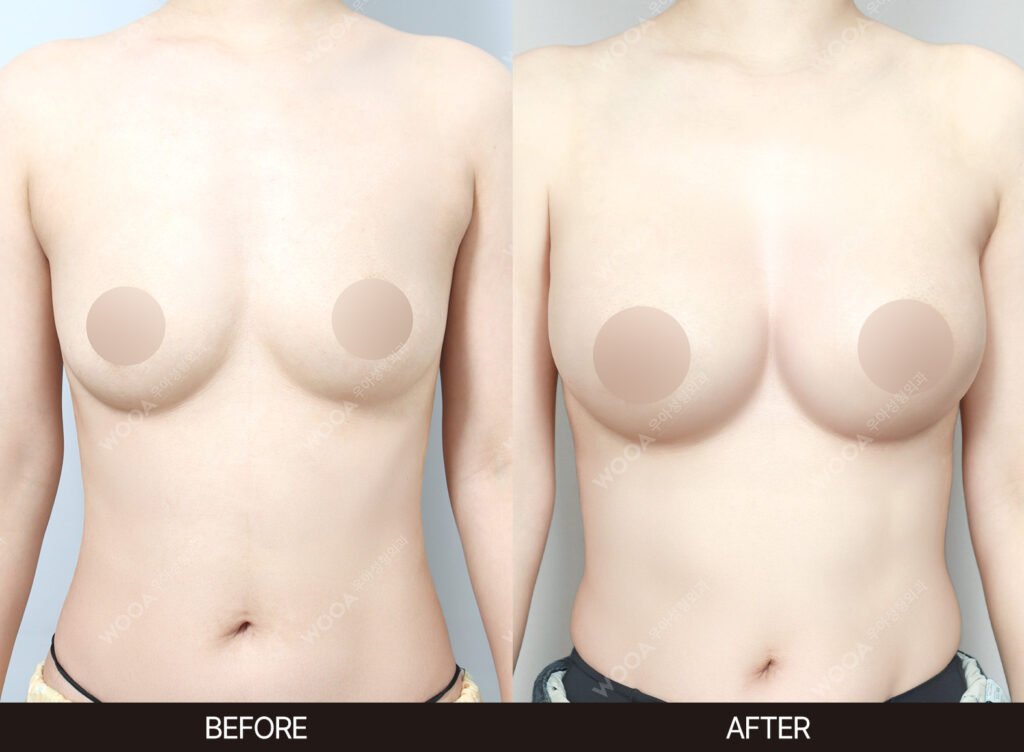 Breast Augmentation before and after – Case 17 – WOOA Plastic Surgery Gangnam