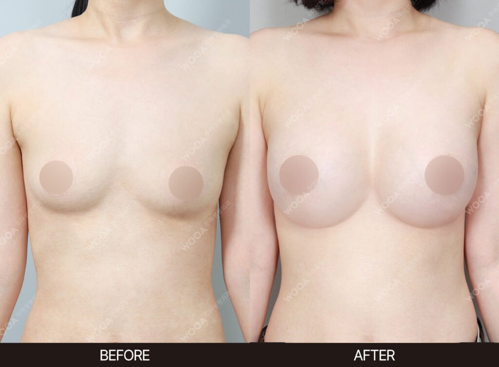 Breast Augmentation before and after – Case 58 – WOOA Plastic Surgery Gangnam