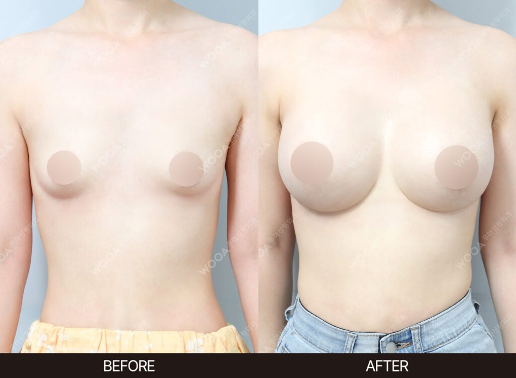 Breast Augmentation before and after – Case 07 – WOOA Plastic Surgery Gangnam